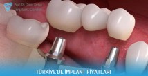 Türkiye’de implant fiyatları