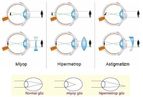 Goz Kusurlari Hastaliklari Biyoloji Konu Anlatim Tyt Ayt Yks